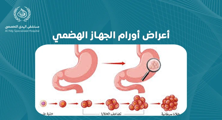 كيف تكتشف أعراض أورام الجهاز الهضمي: علامات يجب الانتباه لها