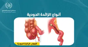 تعرف على أنواع الزائدة الدودية وكيفية التعامل معها