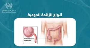 تعرف على أنواع الزائدة الدودية وكيفية التعامل معها