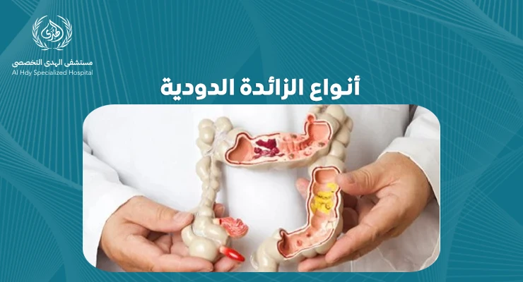 تعرف على أنواع الزائدة الدودية وكيفية التعامل معها