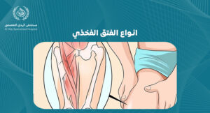 انواع الفتق الفخذي: دليل شامل لفهم الأنواع والأعراض والعلاج