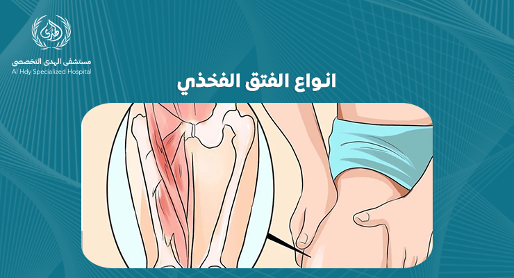 انواع الفتق الفخذي: دليل شامل لفهم الأنواع والأعراض والعلاج