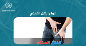 انواع الفتق الفخذي: دليل شامل لفهم الأنواع والأعراض والعلاج