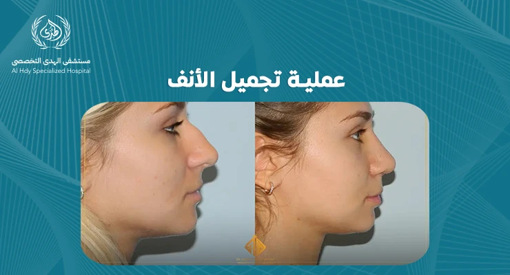 عملية تجميل الأنف: دليل شامل لتحقيق المظهر المثالي - الهدي