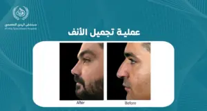 عملية تجميل الأنف: دليل شامل لتحقيق المظهر المثالي - الهدي