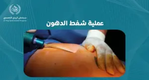 عملية شفط الدهون: دليل شامل لتحقيق الجسم المثالي