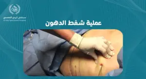 عملية شفط الدهون: دليل شامل لتحقيق الجسم المثالي
