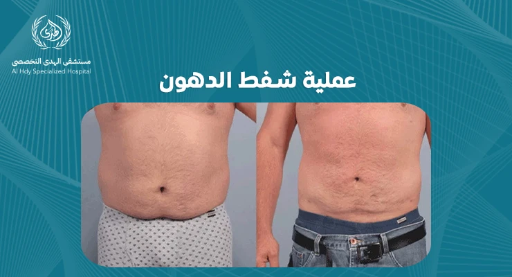 عملية شفط الدهون: دليل شامل لتحقيق الجسم المثالي
