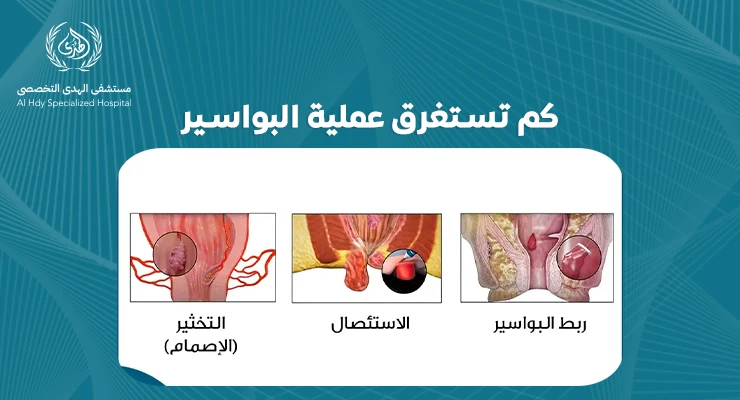 كم تستغرق عملية البواسير: كل ما تحتاج معرفته عن مدة الشفاء