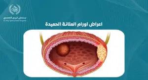 اعراض اورام المثانة الحميدة: كيف تكتشفها مبكرًا وتتعامل معها