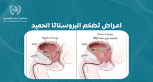 اعراض تضخم البروستاتا الحميد: كيف تكتشفها وتتعامل معها