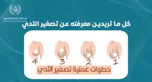 كل ما تريدين معرفته عن تصغير الثدي: نصائح ومعلومات طبية