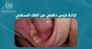 خطوات فعالة لازالة كيس دهني من الفك السفلي: دليل شامل