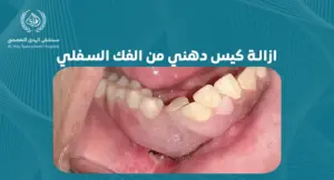 خطوات فعالة لازالة كيس دهني من الفك السفلي: دليل شامل