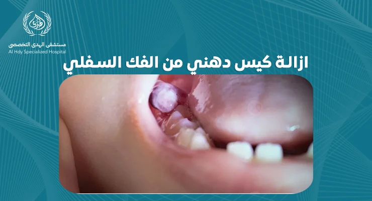 خطوات فعالة لازالة كيس دهني من الفك السفلي: دليل شامل