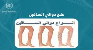 خطوات بسيطة لعلاج دوالي الساقين: نصائح وإرشادات للوقاية
