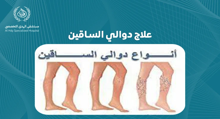 خطوات بسيطة لعلاج دوالي الساقين: نصائح وإرشادات للوقاية