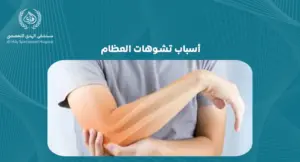 أسباب تشوهات العظام