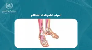 أسباب تشوهات العظام