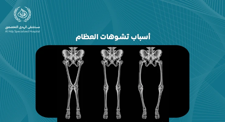 أسباب تشوهات العظام