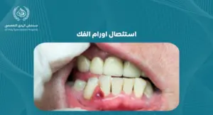 استئصال اورام الفك: خطوات العلاج والتعافي - مستشفي الهدي