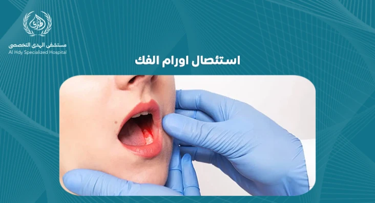 استئصال اورام الفك: خطوات العلاج والتعافي - مستشفي الهدي