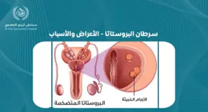 سرطان البروستاتا الأعراض والأسباب: التي يجب أن تعرفها- الهدي