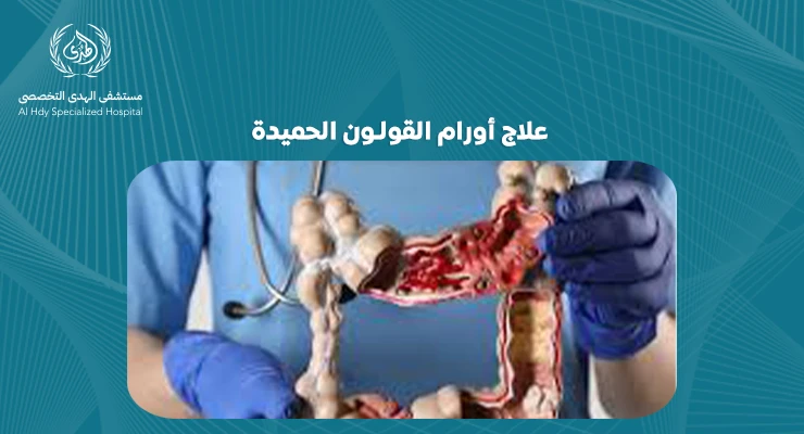 علاج أورام القولون الحميدة