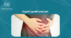 علاج أورام القولون الحميدة