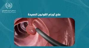 علاج أورام القولون الحميدة