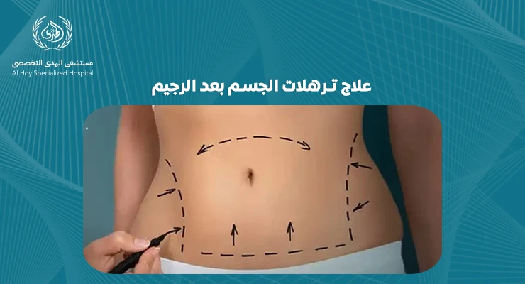 علاج ترهلات الجسم بعد الرجيم