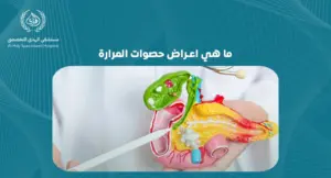 ما هي اعراض حصوات المرارة