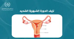 نزيف الدورة الشهرية الشديد