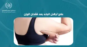 علاج ترهل الجلد بعد فقدان الوزن