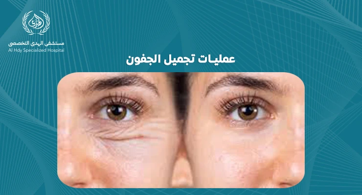 عمليات تجميل الجفون