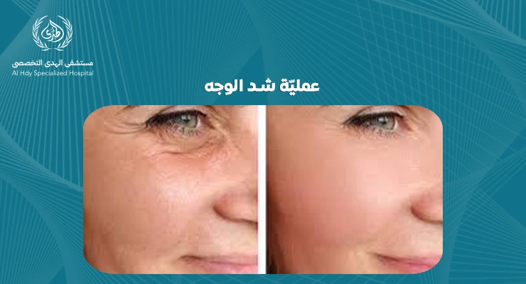 عملية شد الوجه