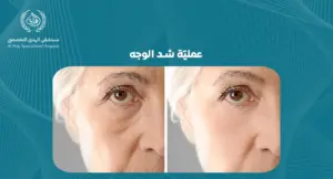 عملية شد الوجه