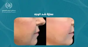 عملية شد الوجه 