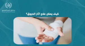 كيف يمكن علاج آثار الحروق؟