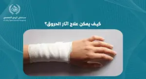 كيف يمكن علاج آثار الحروق؟