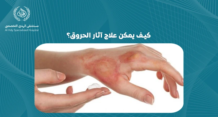 كيف يمكن علاج آثار الحروق؟