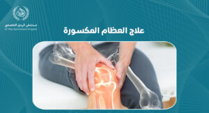 علاج العظام المكسورة